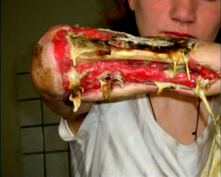 Illustration for article titled Krokodil: Russia's Designer Drug That Will Eat Your Flesh